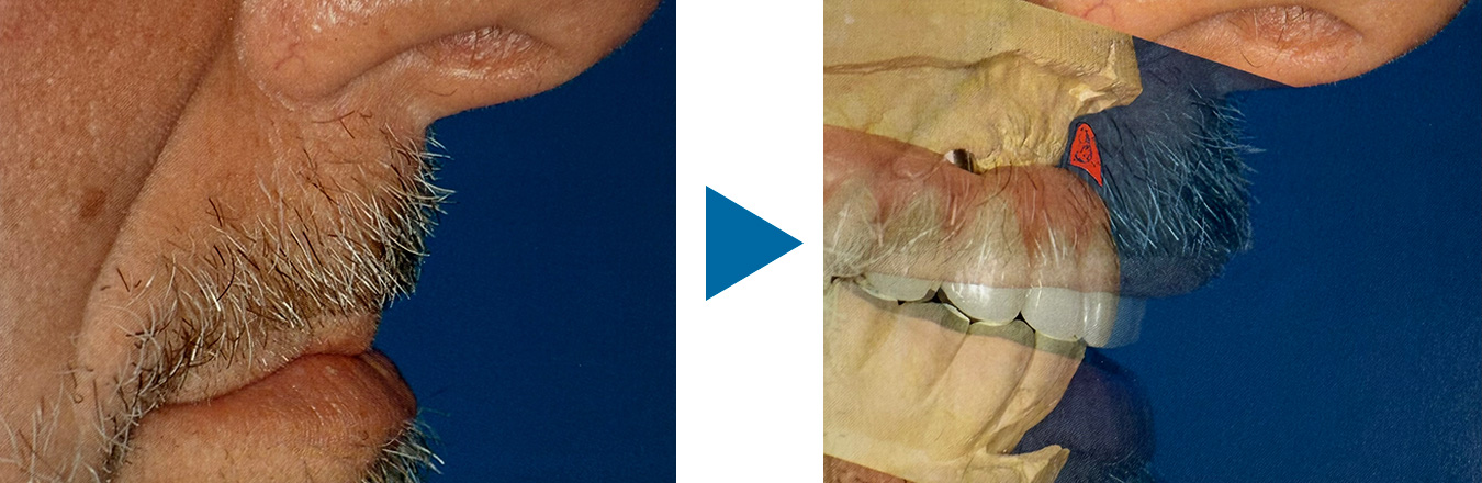 オールオン4とは