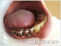 4. もともと両隣が銀歯なので患者さまは銀色の歯を希望されました。