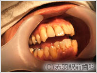 3. セラミック人工歯セット 