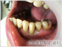 5.セラミックの歯を入れて完成。両隣の虫歯も治療してより自然になりました。