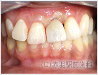 4. もともと両隣が銀歯なので患者さまは銀色の歯を希望されました。