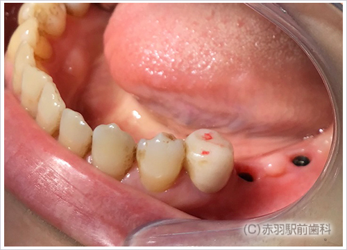 2. インプラントを希望されたので、抜歯と同時にその穴にインプラントを埋入。