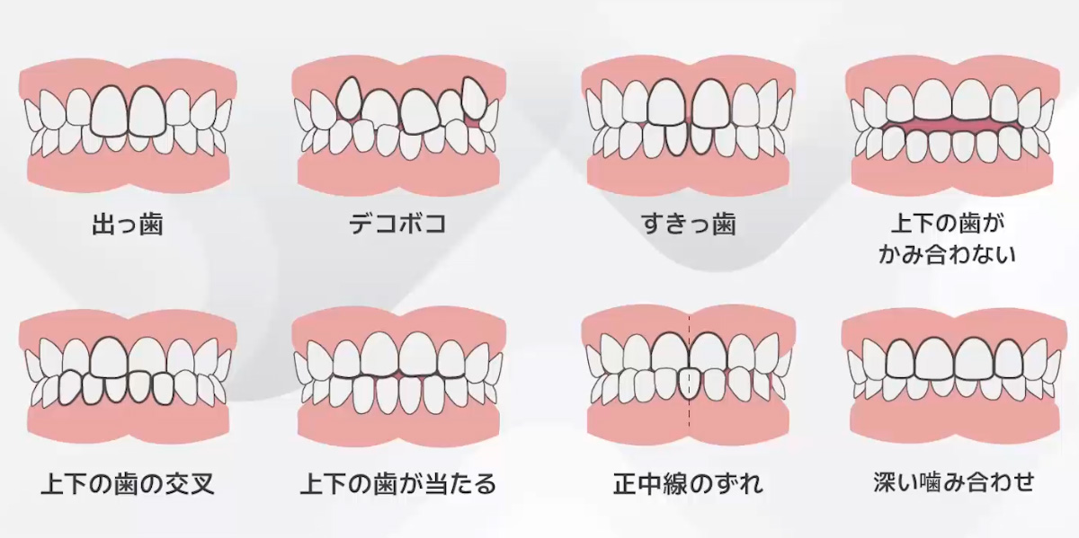 不正咬合とは？