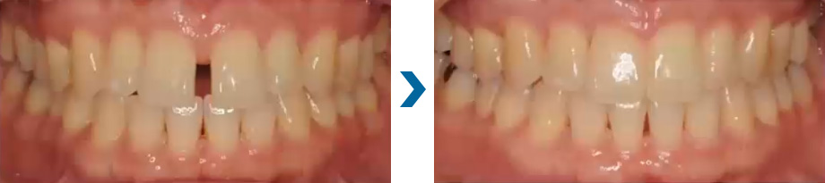 すきっ歯　治療例①