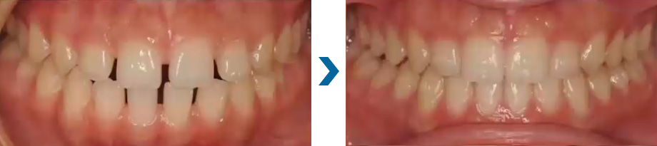 すきっ歯　治療例②