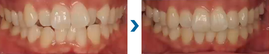 デコボコ　治療例①