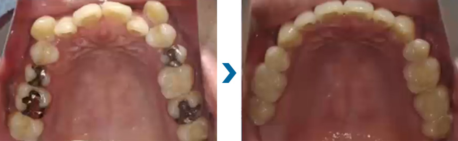 デコボコ　治療例②