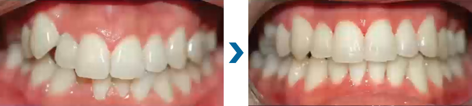 深い嚙み合わせ　治療例②