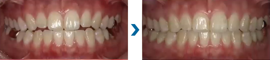 上下の歯が当たる　治療例