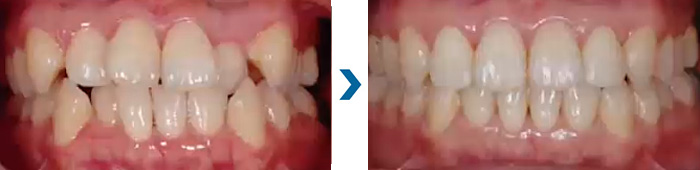 マウスピース型歯列矯正とは？