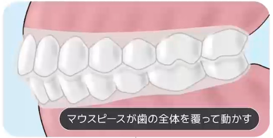 マウスピース矯正