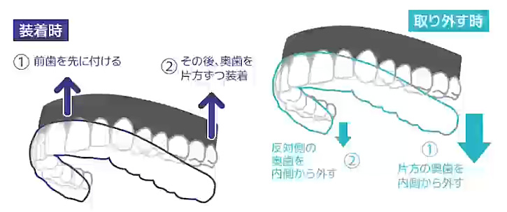 マウスピースの素材