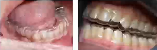マウスピースが浮いている状態